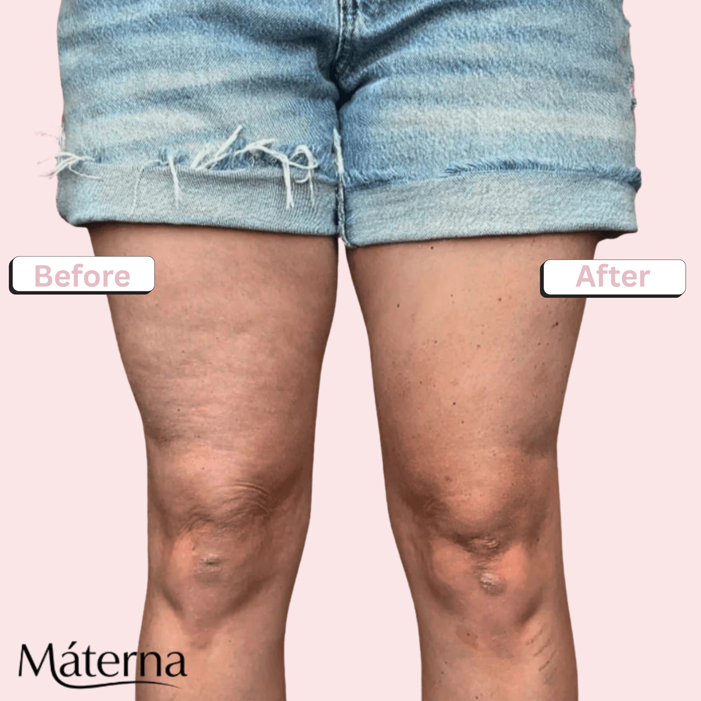 Materna: The Cellu-Smooth Patch™