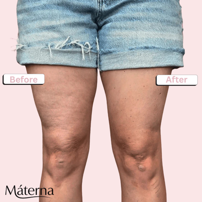 Materna: The Cellu-Smooth Patch™