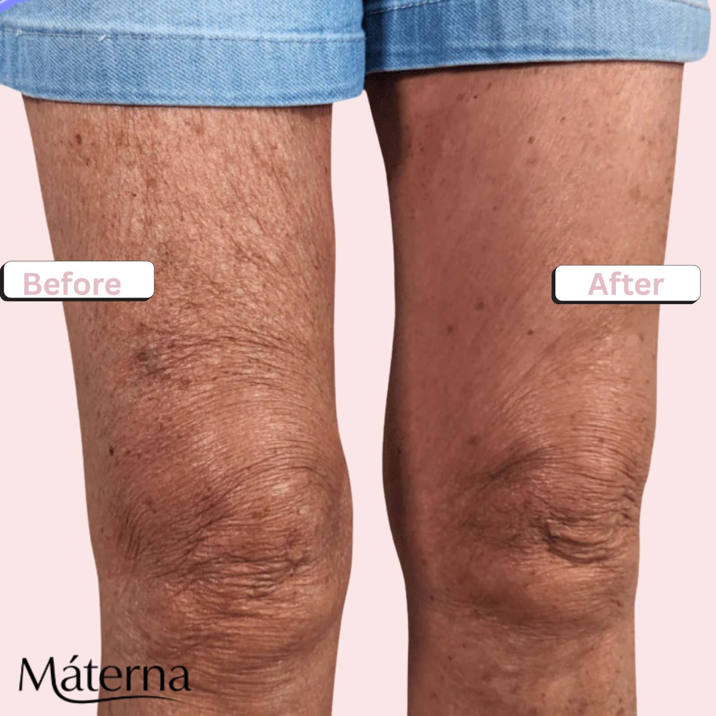 Materna: The Cellu-Smooth Patch™