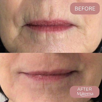 Materna™ Silicone Scar Sheets