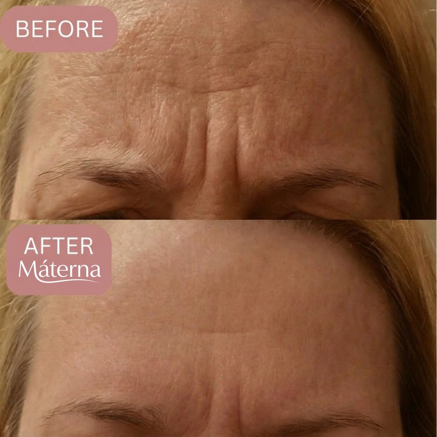Materna™ Silicone Scar Sheets