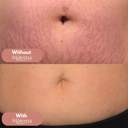 Silicone StretchMark Pack