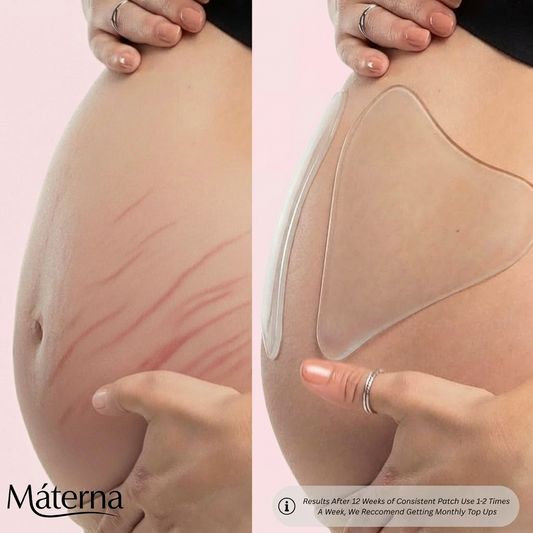 Silicone StretchMark Prevention Pack™